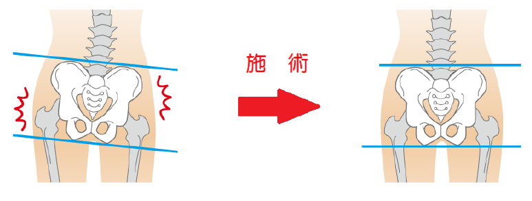 骨のアライメントの調整（歪みの調整）
